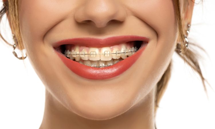 Brackets estéticos: qué son, cuánto duran y diferencias